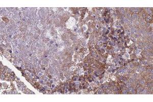 ABIN6276868 at 1/100 staining Human urothelial cancer tissue by IHC-P. (IFNAR2 Antikörper)