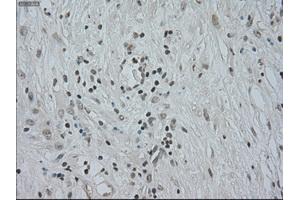 Immunohistochemical staining of paraffin-embedded Carcinoma of kidney tissue using anti-CTAG1Bmouse monoclonal antibody. (CTAG1B Antikörper)