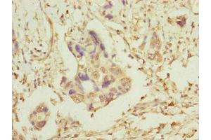 Immunohistochemistry of paraffin-embedded human pancreatic cancer using ABIN7159918 at dilution of 1:100 (TOMM34 Antikörper  (AA 1-309))