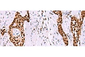 Immunohistochemistry of paraffin-embedded Human esophagus cancer tissue using ISY1-RAB43 Polyclonal Antibody at dilution of 1:55(x200) (ISY1-RAB43 Readthrough (ISY1-RAB43) Antikörper)