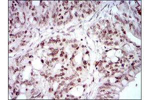 Immunohistochemical analysis of paraffin-embedded rectum cancer tissues using HOXB4 mouse mAb with DAB staining. (HOXB4 Antikörper  (AA 16-251))