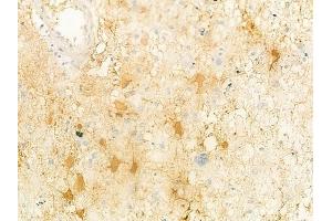 ABIN6261917 and ABIN6278468 at 1/100 staining human astrocytoma by IHC-P. (GUCY1A1 Antikörper  (C-Term))