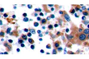 Detection of CTLA4 in Human Tonsil Tissue using Polyclonal Antibody to Cytotoxic T-Lymphocyte Associated Antigen 4 (CTLA4) (CTLA4 Antikörper  (AA 52-211))