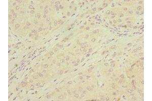 Immunohistochemistry of paraffin-embedded human liver cancer using ABIN7159068 at dilution of 1:100 (MMP19 Antikörper  (AA 209-508))