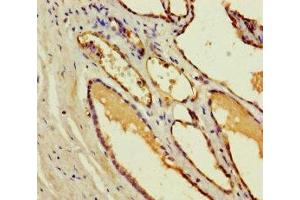 Immunohistochemistry of paraffin-embedded human prostate cancer using ABIN7148974 at dilution of 1:100 (CST11 Antikörper  (AA 1-138))