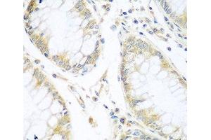 Immunohistochemistry of paraffin-embedded Human gastric cancer using CUL3 Polyclonal Antibody at dilution of 1:100 (40x lens). (Cullin 3 Antikörper)
