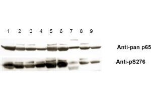 Anti-pS276 shows phospho p65 staining in carcinoma cells. (NF-kB p65 Antikörper  (pSer276))