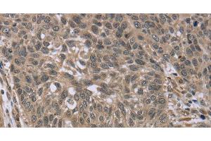 Immunohistochemistry of paraffin-embedded Human lung cancer tissue using IL15RA Polyclonal Antibody at dilution 1:45 (IL15RA Antikörper)