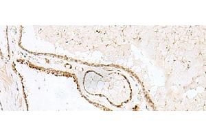 Immunohistochemistry of paraffin-embedded Human thyroid cancer tissue using GSKIP Polyclonal Antibody at dilution of 1:55(x200)