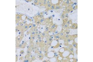 Immunohistochemistry of paraffin-embedded human liver injury using NDUFA7 antibody. (NDUFA7 Antikörper  (AA 1-113))