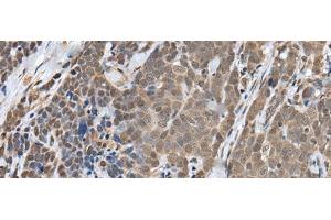 Immunohistochemistry of paraffin-embedded Human thyroid cancer tissue using ZNF410 Polyclonal Antibody at dilution of 1:40(x200) (ZNF410 Antikörper)