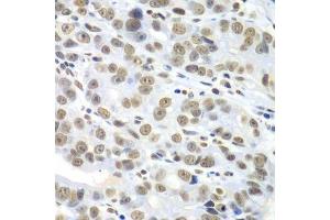 Immunohistochemistry of paraffin-embedded human gastric cancer using HDAC2 antibody. (HDAC2 Antikörper  (C-Term))