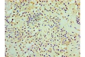 Immunohistochemistry of paraffin-embedded human breast cancer using ABIN7167634 at dilution of 1:100 (RMDN3 Antikörper  (AA 1-470))