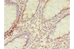 Immunohistochemistry of paraffin-embedded human colon cancer using ABIN7173091 at dilution of 1:100 (TMEM165 Antikörper  (AA 173-228))