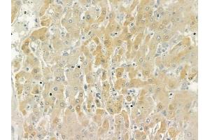 ABIN6258978 and ABIN6276019 at 1/100 staining human hepatocellular carcinoma by IHC-P.