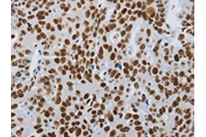 The image on the left is immunohistochemistry of paraffin-embedded Human ovarian cancer tissue using ABIN7192399(SLC16A14 Antibody) at dilution 1/80, on the right is treated with synthetic peptide. (SLC16A14 Antikörper)