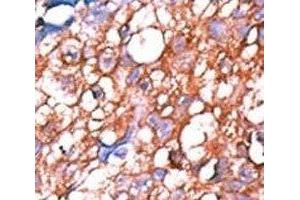 IHC analysis of FFPE human hepatocarcinoma tissue stained with the phospho-ERBB4 antibody. (ERBB4 Antikörper  (pTyr1162))