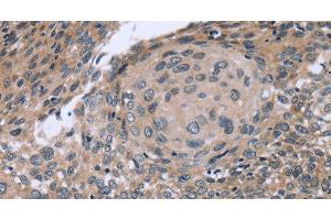 Immunohistochemistry of paraffin-embedded Human cervical cancer using p53RFP Polyclonal Antibody at dilution of 1:50 (RNF144B Antikörper)