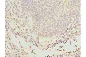 Immunohistochemistry of paraffin-embedded human bladder cancer using ABIN7154238 at dilution of 1:100 (GLT1D1 Antikörper  (AA 17-152))