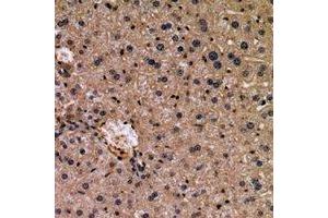 Immunohistochemical analysis of WISP3 staining in human liver cancer formalin fixed paraffin embedded tissue section. (WISP3 Antikörper  (N-Term))