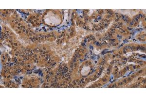 Immunohistochemistry of paraffin-embedded Human thyroid cancer using MCTS1 Polyclonal Antibody at dilution of 1:60 (MCTS1 Antikörper)