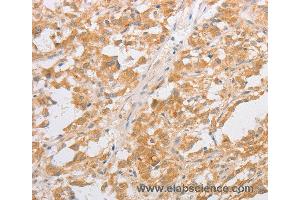Immunohistochemistry of Human thyroid cancer using CDKN2AIP Polyclonal Antibody at dilution of 1:40 (CDKN2AIP Antikörper)