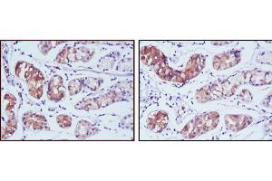 Immunohistochemical analysis of paraffin-embedded human stomach cancer tissues using PGA5 mouse mAb with DAB staining. (PGA5 Antikörper)