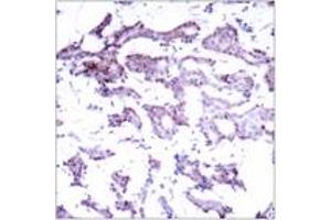 Immunohistochemistry analysis of paraffin-embedded human breast carcinoma tissue, using Elk1 (Ab-389) Antibody.