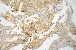 Immunohistochemistry was performed on paraffin-embedded human endometrial carcinoma using SRPK2 antibody (ABIN7800327), 1:200). (SRPK2 Antikörper)