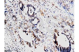 Formalin-fixed and paraffin embedded human colon carcinoma labeled with Anti-MMP-1 Polyclonal Antibody, Unconjugated (ABIN668931) at 1:200, followed by conjugation to the secondary antibody and DAB staining