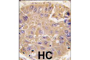 Formalin-fixed and paraffin-embedded human hepatocellular carcinoma reacted with METAP2 polyclonal antibody  , which was peroxidase-conjugated to the secondary antibody, followed by DAB staining .