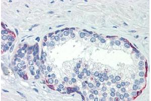 Human Prostate (formalin-fixed, paraffin-embedded) stained with PLEKHH2 antibody ABIN462253 followed by biotinylated goat anti-rabbit IgG secondary antibody ABIN481713, alkaline phosphatase-streptavidin and chromogen. (PLEKHH2 Antikörper  (AA 1043-1092))