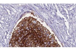 ABIN6276812 at 1/100 staining Human urothelial cancer tissue by IHC-P. (SLC22A5 Antikörper  (C-Term))