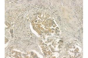 ABIN6258523 and ABIN6274745 at 1/100 staining human lung squamous cell carcinoma by IHC-P. (MRPL51 Antikörper  (C-Term))