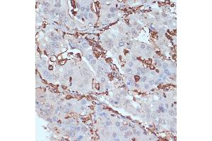 Immunohistochemistry of paraffin-embedded human liver cancer using HLA-DRA antibody (ABIN6131757, ABIN6141827, ABIN6141829 and ABIN6215475) at dilution of 1:100 (40x lens). (HLA-DRA Antikörper  (AA 26-216))