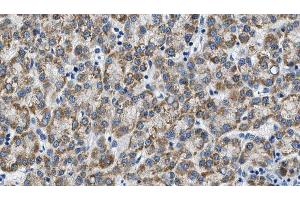ABIN6274603 at 1/100 staining Human liver cancer tissue by IHC-P. (P-Cadherin Antikörper  (N-Term))