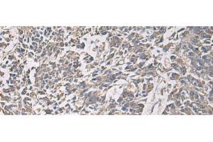 Immunohistochemistry of paraffin-embedded Human colorectal cancer tissue using PRKCSH Polyclonal Antibody at dilution of 1:90(x200) (PRKCSH Antikörper)