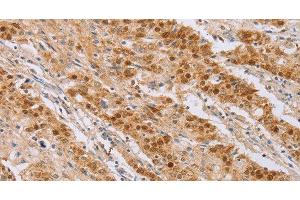 Immunohistochemistry of paraffin-embedded Human gastic cancer using CDC46 Polyclonal Antibody at dilution of 1:40 (MCM5 Antikörper)