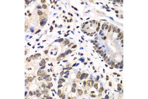 Immunohistochemistry of paraffin-embedded human gastric cancer using RBBP7 antibody. (RBBP7 Antikörper  (AA 1-230))