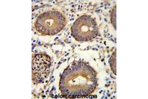 Immunohistochemistry (IHC) image for anti-Carcinoembryonic Antigen Gene Family (CEA) antibody (ABIN3002653) (CEA Antikörper)