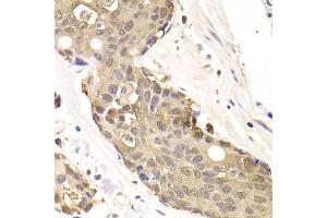 Immunohistochemistry of paraffin-embedded human colon carcinoma using FKBP4 Antibody (ABIN5973289) at dilution of 1/200 (40x lens). (FKBP4 Antikörper)