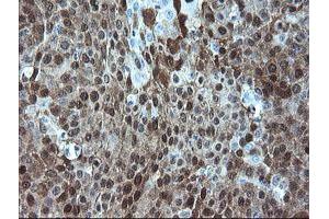 Immunohistochemical staining of paraffin-embedded Carcinoma of Human lung tissue using anti-ADH7 mouse monoclonal antibody. (ADH7 Antikörper)