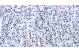 Immunohistochemistry of paraffin-embedded Human thyroid cancer using PAX8 Polyclonal Antibody at dilution of 1:35 (PAX8 Antikörper)