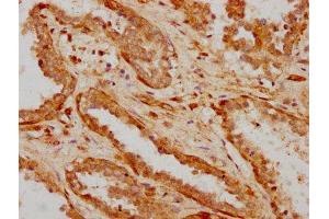 IHC image of ABIN7156114 diluted at 1:600 and staining in paraffin-embedded human prostate cancer performed on a Leica BondTM system. (ILDR1 Antikörper  (AA 393-541))