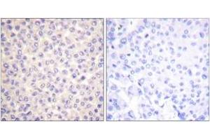 Immunohistochemistry analysis of paraffin-embedded human breast carcinoma, using FADD (Phospho-Ser194) Antibody. (FADD Antikörper  (pSer194))