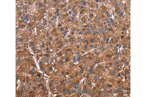 Immunohistochemistry of Human colon cancer using ELP2 Polyclonal Antibody at dilution of 1:40 (ELP2 Antikörper)