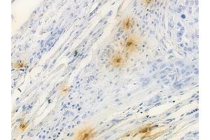 ABIN6257001 and ABIN6274697 at 1/100 staining human tongue carcinoma by IHC-P. (PHLDA1 Antikörper  (N-Term))
