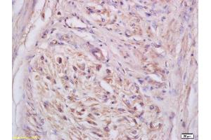 Formalin-fixed and paraffin embedded human cervical carcinoma labeled with Anti-NKG2C Polyclonal Antibody, Unconjugated (ABIN739950) at 1:200 followed by conjugation to the secondary antibody and DAB staining