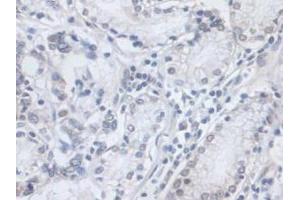 IHC-P analysis of Human Stomach Cancer Tissue, with DAB staining. (VCP Antikörper  (AA 125-371))