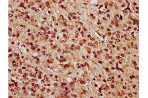 IHC image of ABIN7163751 diluted at 1:100 and staining in paraffin-embedded human glioma performed on a Leica BondTM system. (PARP3 Antikörper  (AA 1-240))